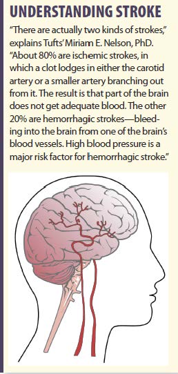 stroke affecting right side