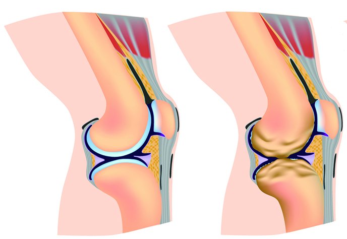 Knee Arthritis