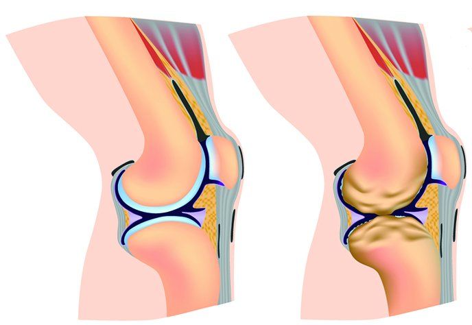 Osteoarthritis adalah