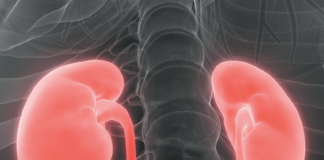 Kidney Stones