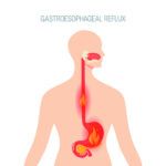 GERD concept in flat style, vector illustration