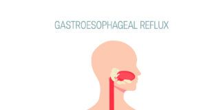 GERD concept in flat style, vector illustration