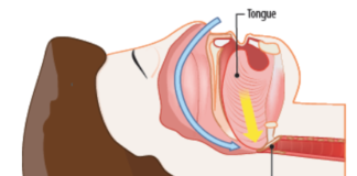 In obstructive sleep apnea, the airway is blocked. People with this condition will stop breathing and then gasp for air while sleeping.