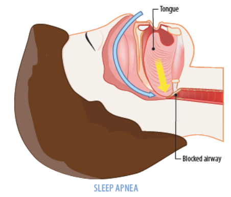 In obstructive sleep apnea, the airway is blocked. People with this condition will stop breathing and then gasp for air while sleeping.