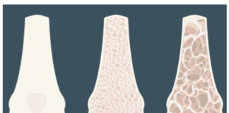 Loss of bone density leads to weak, porous bones (like those on the right) that break easily.