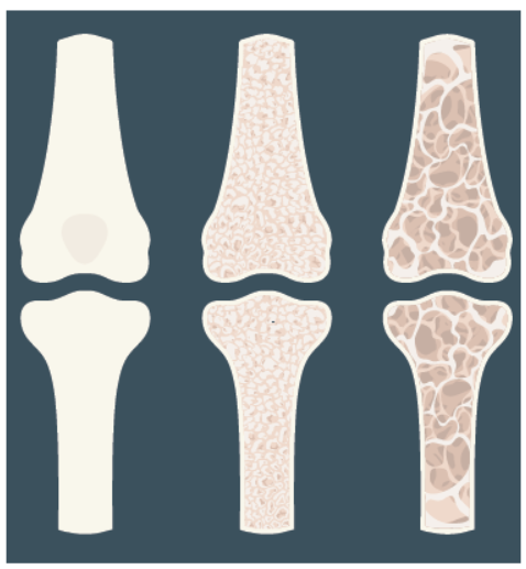 Loss of bone density leads to weak, porous bones (like those on the right) that break easily.