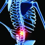 Recurrent Low Back Pain? Try Walking