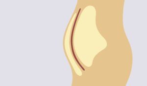 Body Roundness Index Proposed to Replace Body Mass Index