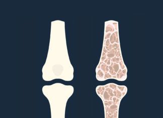 Ultraprocessed Foods Associated with Lower Bone Health Measures