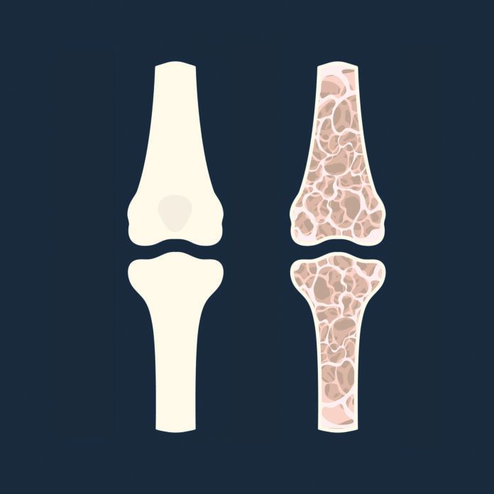 Osteoporosis, conceptual illustration