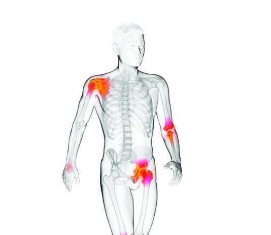5 Arthritis Food Myths