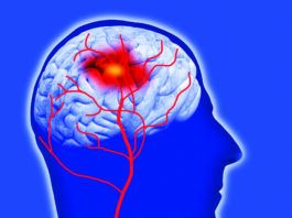 Modifiable Stroke Risk Factors Should be Addressed