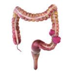 Certain Dietary Traits Are Associated with Lower Colorectal Cancer Risk