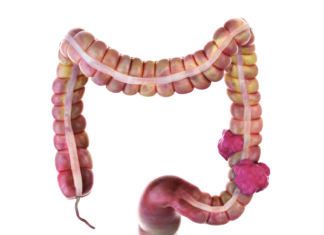 Certain Dietary Traits Are Associated with Lower Colorectal Cancer Risk