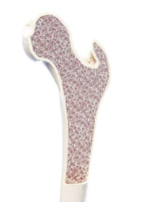 Osteoporosis Screening Recommended for All Women over 6