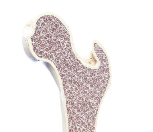 Osteoporosis Screening Recommended for All Women over 6