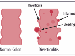 Old Advice for Avoiding Diverticulitis May be Revised