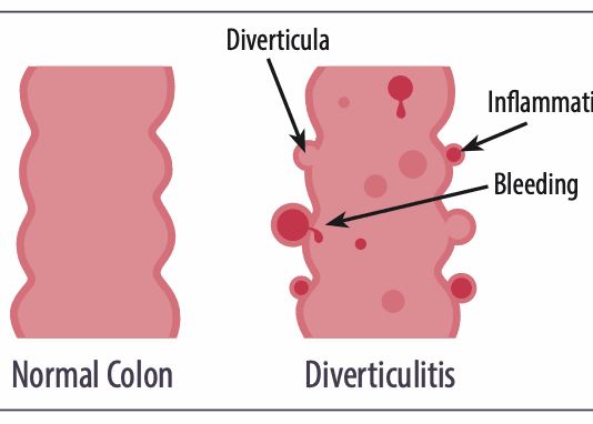 Old Advice for Avoiding Diverticulitis May be Revised