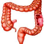 Reduce Alcohol Intake to Lower Colorectal Cancer Risk