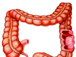 Reduce Alcohol Intake to Lower Colorectal Cancer Risk