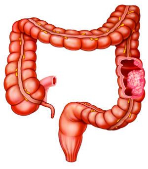 Reduce Alcohol Intake to Lower Colorectal Cancer Risk