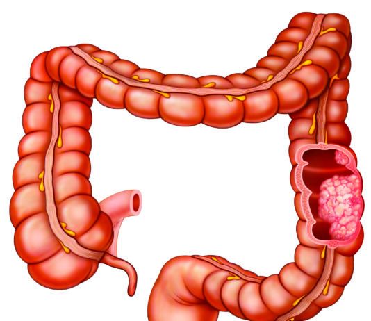 Reduce Alcohol Intake to Lower Colorectal Cancer Risk