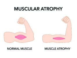 Extra Protein Does Not Preserve Muscle Size or Function with Age