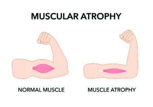 Extra Protein Does Not Preserve Muscle Size or Function with Age